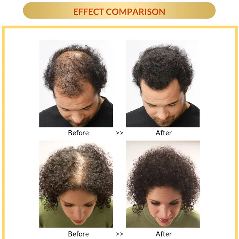 

Hair Growth Essence Spray Hair Loss Treatment Serum Nourish Roots Easy To Carry Fast Germinal Hair Care for Men Women 30g