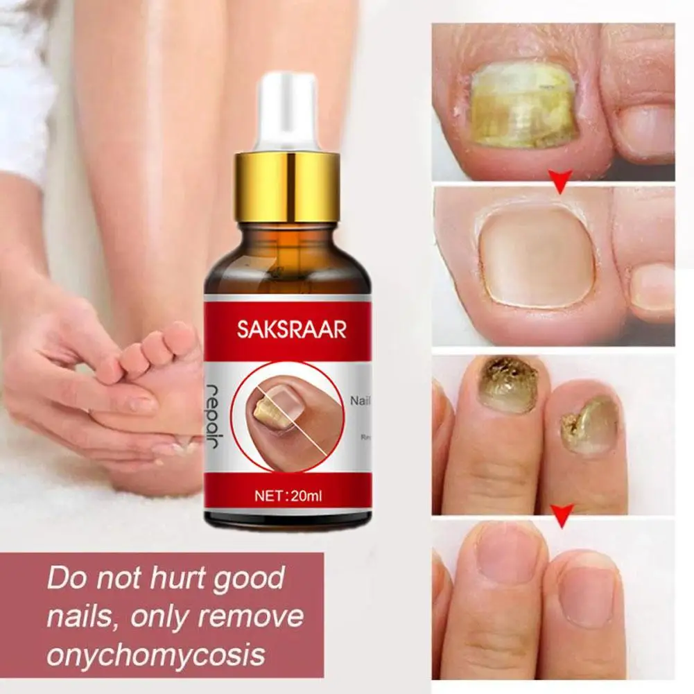 

Nail Fungal Treatment Feet Care Repair Essence Foot Whitening Toe Nail Fungus Removal Gel Anti Infection Paronychia Onychomycosi