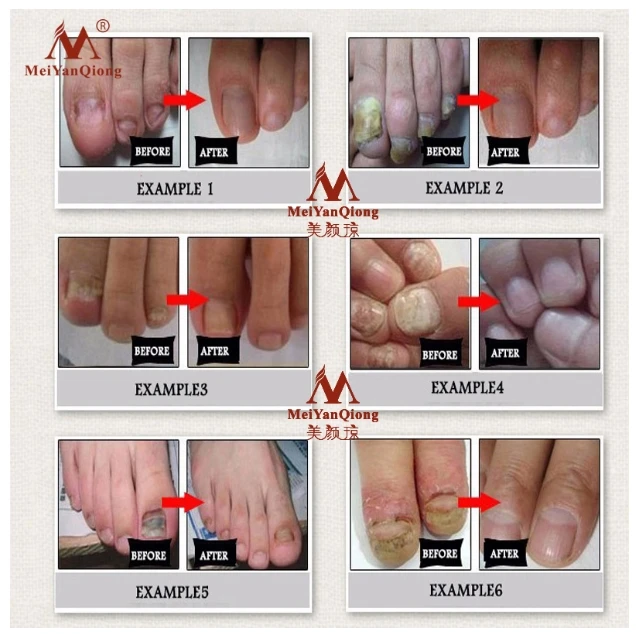 Средство для лечения грибка ногтей эссенция ухода за ногами отбеливающий гель