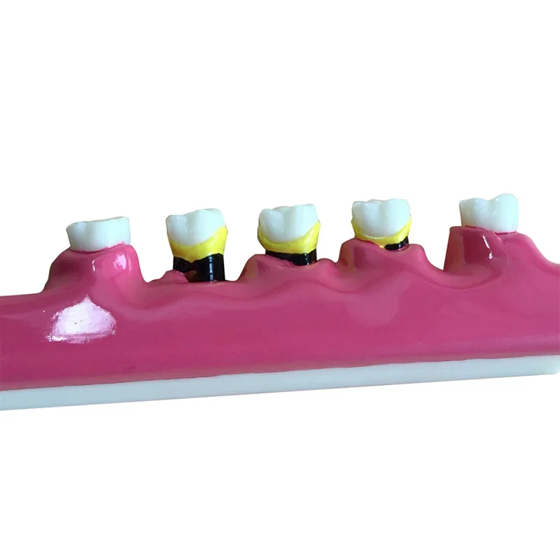 Стоматологическая модель зубов Пародонтоз ассортная классификации зубов|dental