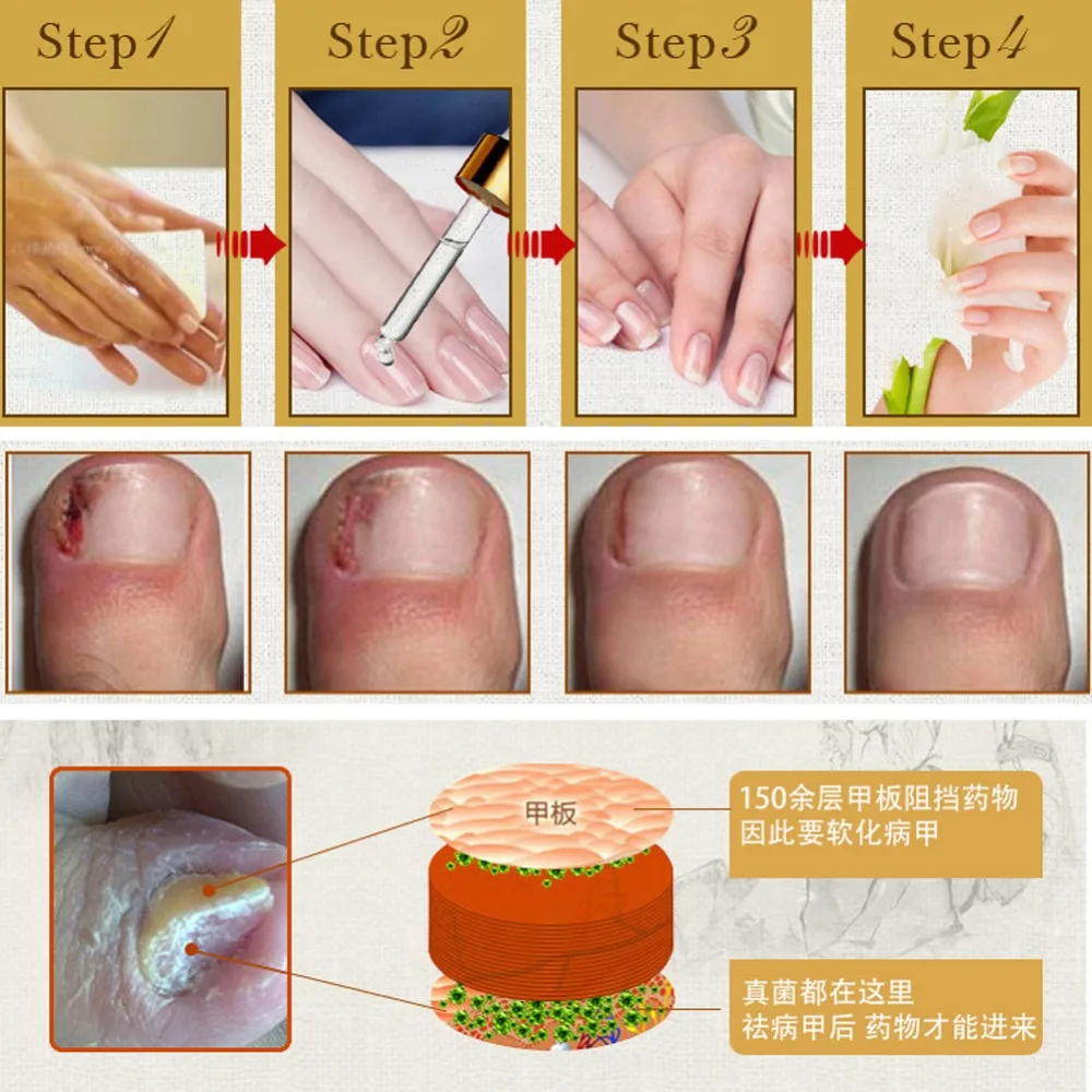 

Fungal Nail Treatment Essence Nail and Foot Whitening Toe Nail Fungus Removal Feet Care Nail