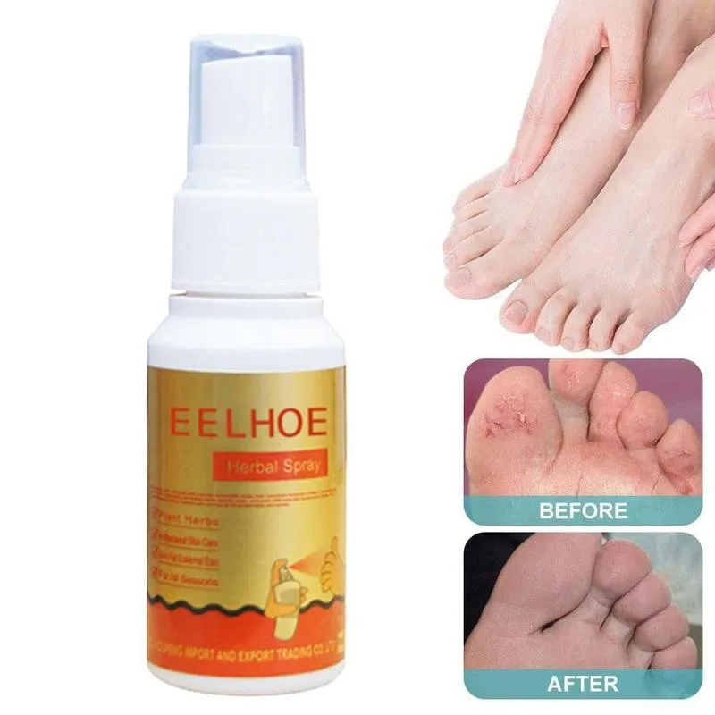 

30ml Natural Herbal Athletes Foot Spray Feet Care Remove Foot Odor Treatment Spray For Itchy Sweaty Feet