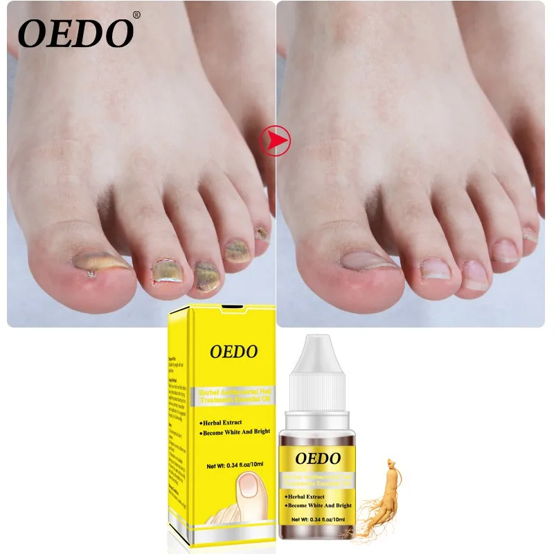 

Fungal Nail Treatment Feet Care Essence Nail Anti Infection Paronychia Onychomycosis Foot Whitening Toe Nail Fungus Removal Gel