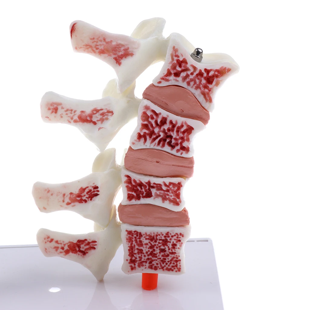 

1:1 Human Medical Lumbar Vertebra Thighbone Osteoporosis Pathology Model Kit