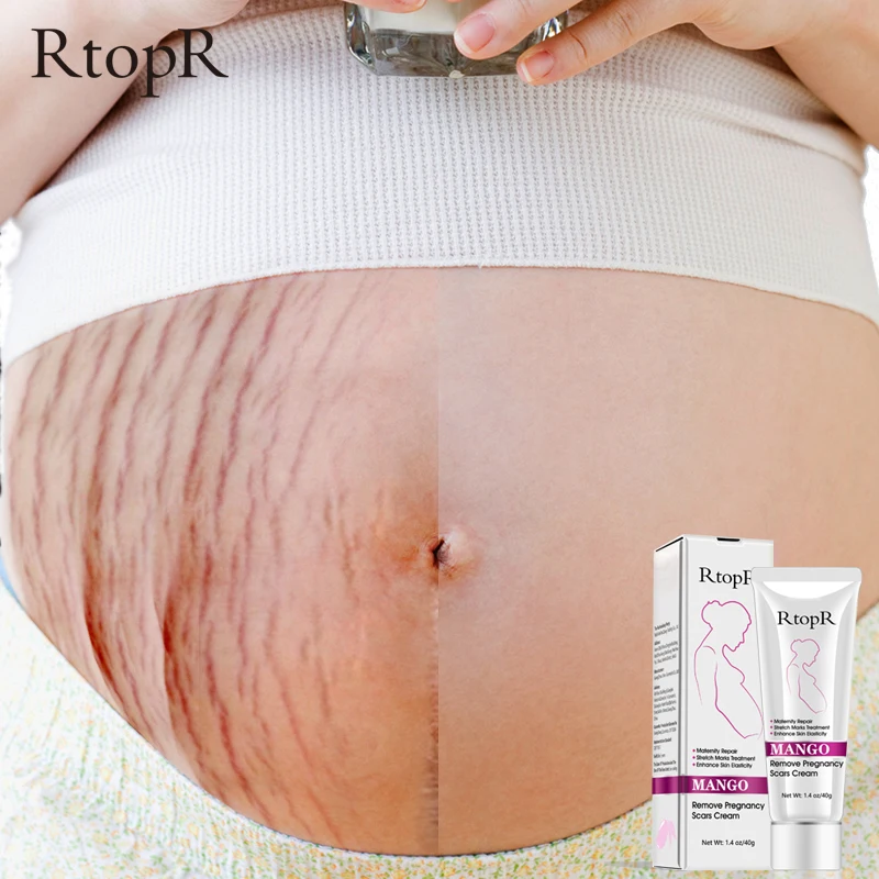 

RTOPR Mango Remove Pregnancy Scars Acne Cream Stretch Marks Treatment Maternity Repair Anti-Aging Anti Winkle Firming Body Cream