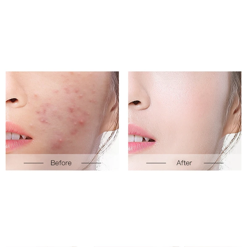 Морская соль мыло ручной работы анти клещи контроль маслом стойкий Питательный