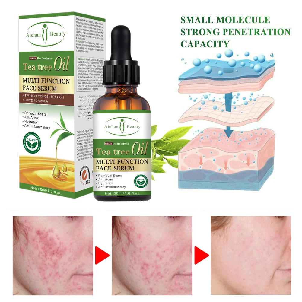 Эссенция чайного дерева для лечения акне средство удаления пятен контроль