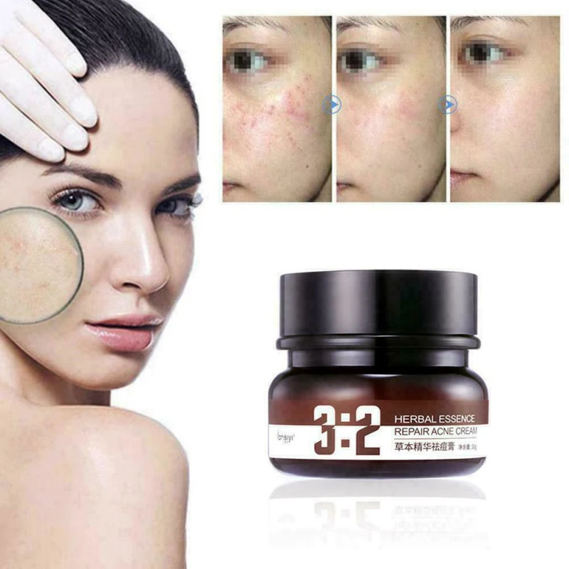 

30g Herbal Acne Cream To Remove Acne Cream, Shrink Pores, Control Acne Spots, Oil, Whiten And Moisturize Acne Cream