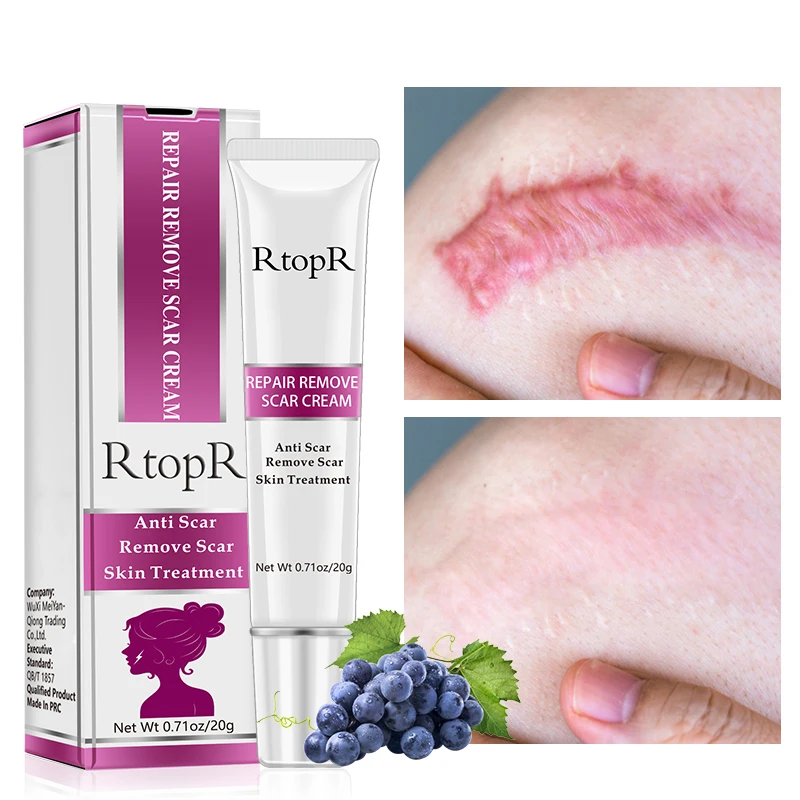 

RtopR Acne Scar Stretch Marks Remover Cream Skin Repair Acne Spots Blackhead Whitening Cream Skin Care Acne Treatment