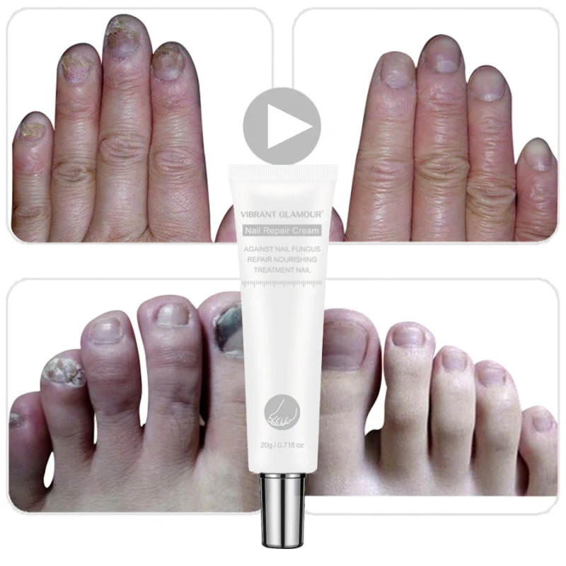 Яркие Гламурные 20g гвоздь ToeRepair крем Лечение грибка ногтей онихомикоз удаления