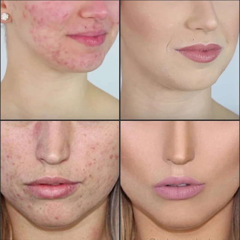 30 мл эфирное масло чайного дерева укрепляющее кожу гладкие тонкие линии