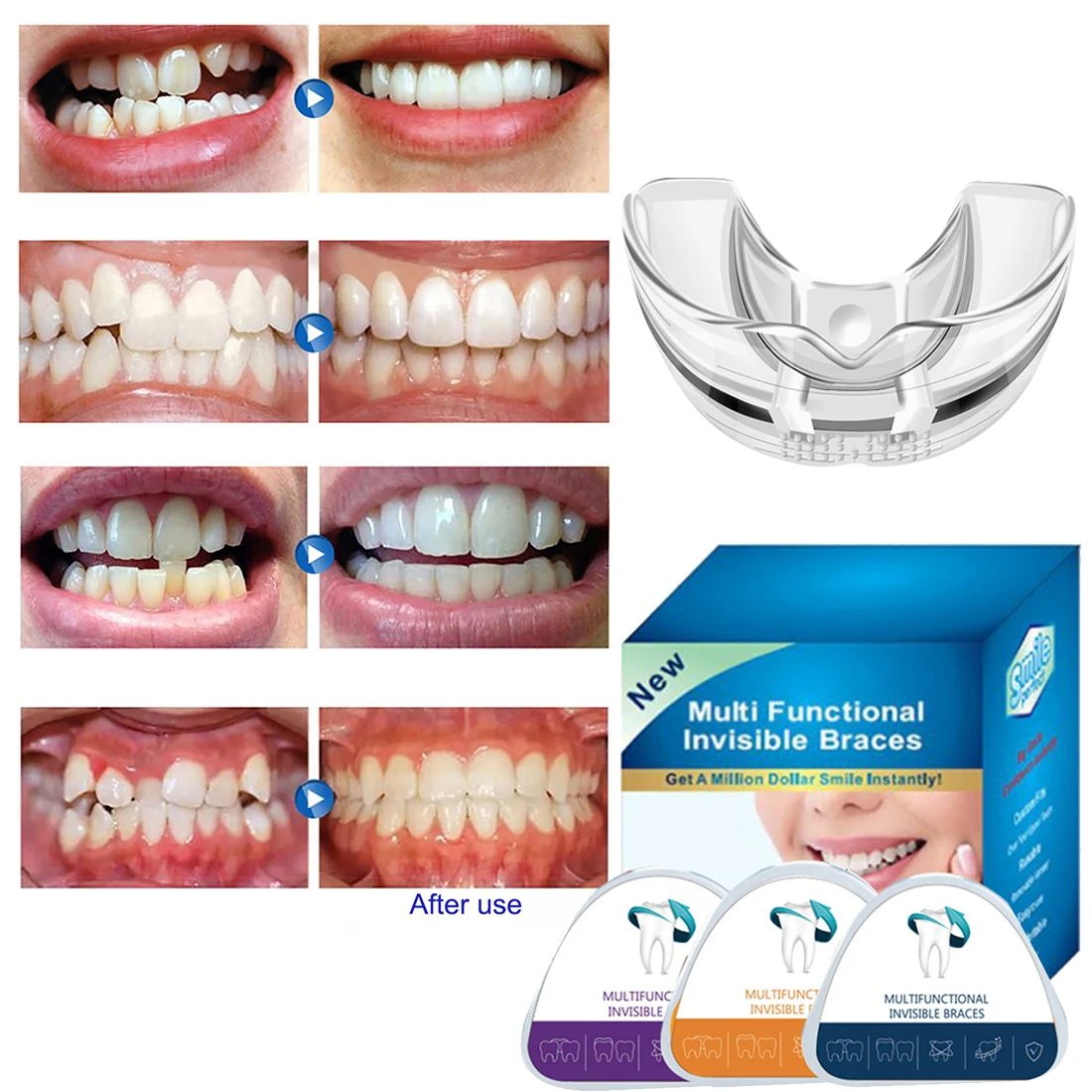 

3 этапа, зубные скобы, выпрямитель зубов, ортодонтические скобы для выравнивания зубов, бруксизм, Защита рта, ортодонтический корректор