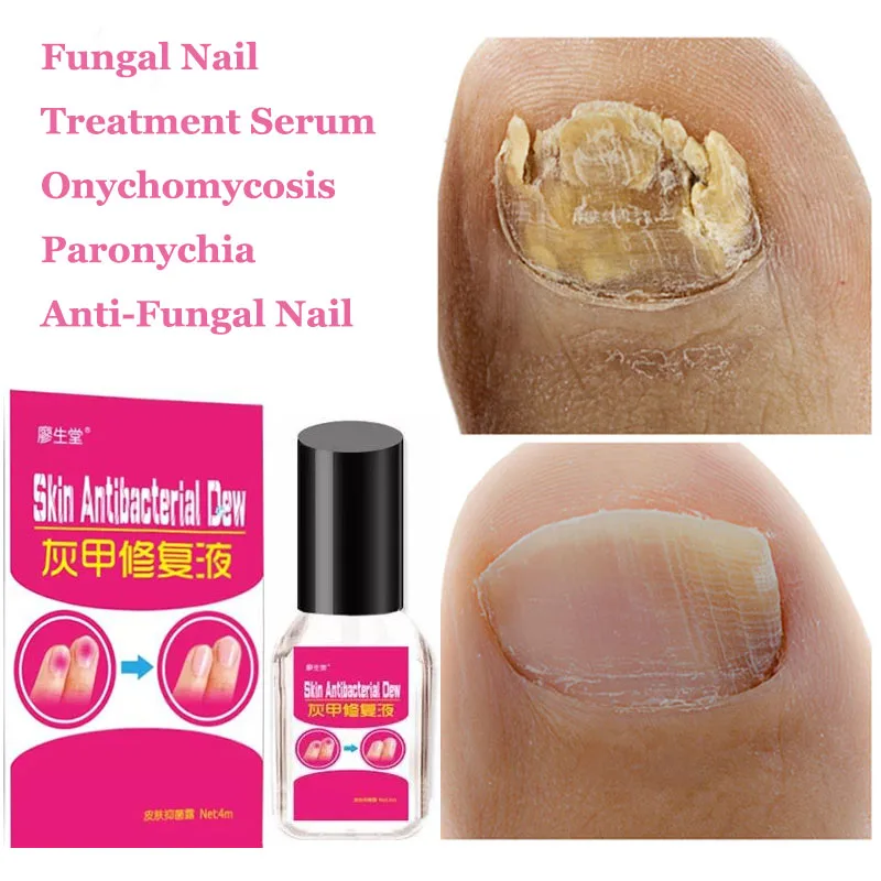 

Эссенция для лечения Ногтей от грибков, средство для удаления грибка на ногтях, отбеливание, онихомико, уход за ногами, гель для ногтей, инст...