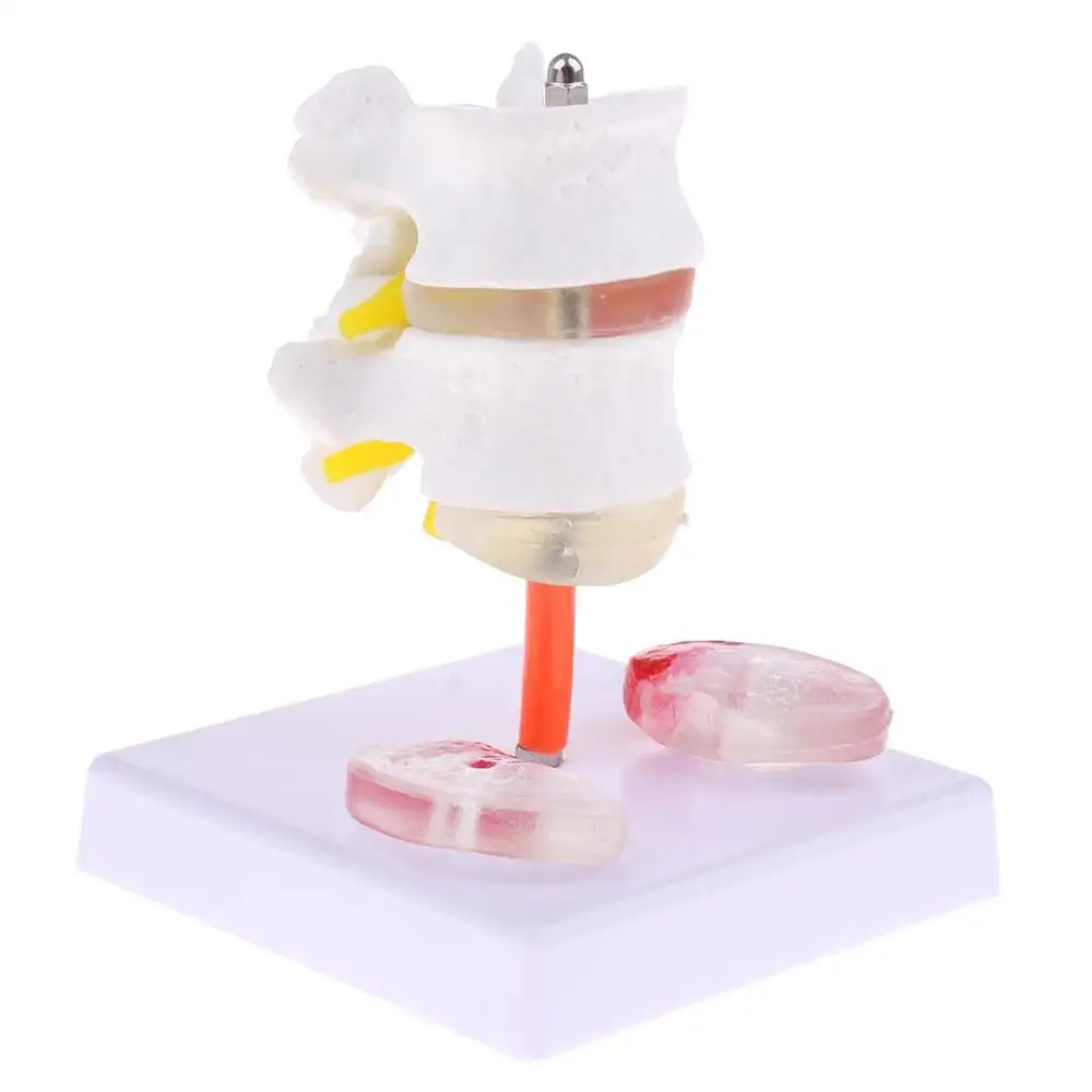 Медицинский Скелет с двумя поясничными позвонками и больным межпозвоночным