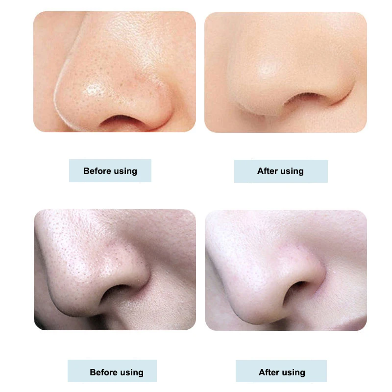 

Vacuum Blackhead Removal Instrument 6 Suction Heads 3 Gears Facial Pore Cleansing Remove Blackhead Acne Skin Care Beauty Device