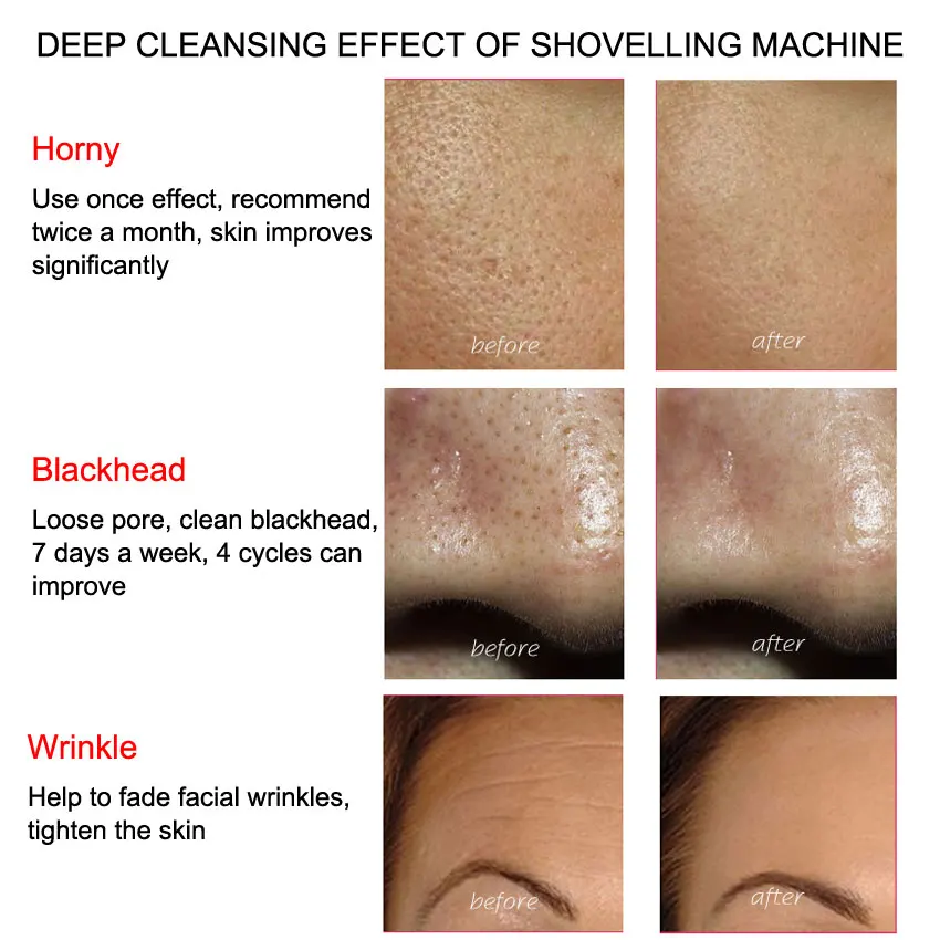 Профессиональный ультразвуковой скребок для кожи лица Ион глубокое очищение