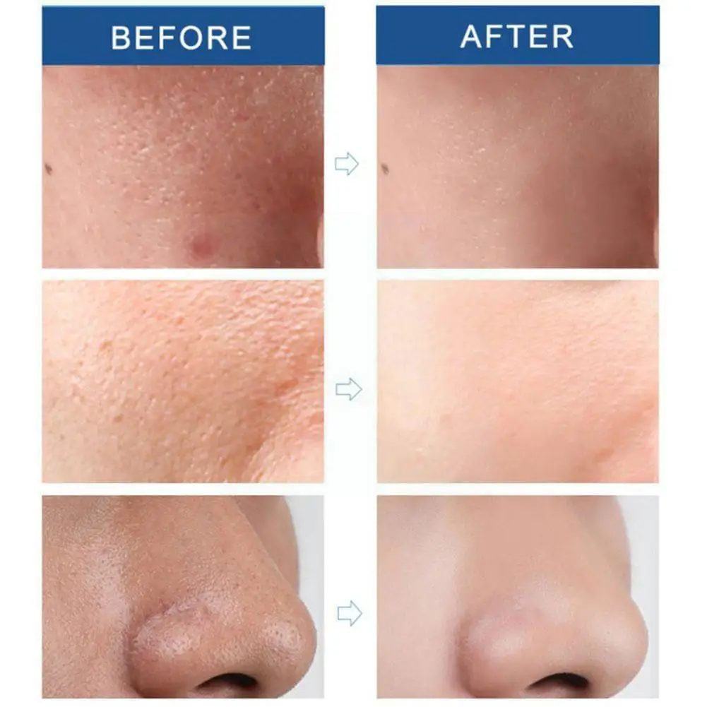 

Жидкость для удаления черных точек, 10 мл