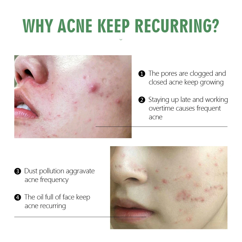 

VIBRANT GLAMOUR Tea Tree Serum Acne Treatment Natural Repair Whitening Moisturizing Oil Control Improve Sensitive Skin Care 30ml
