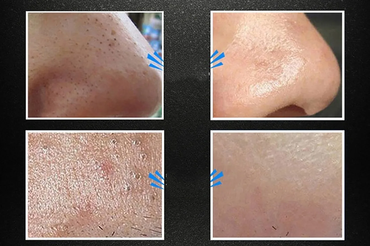 

Bamboo Charcoal Blackhead Remover Cleaner Black Dot Face Ance Black Dots Blackhead Point Vacuum Pore Cleaner Skin Care