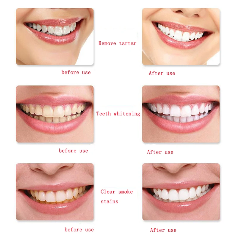 

5 pcs/lot Teeth Whitening Gel 22% ,35%,44% available Carbamide Peroxide 6% 12% Hydrogen Peroxide Dental Whitener high quality