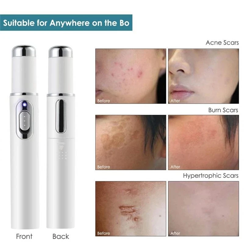 

Wholesale Blue Light Therapy Varicose Veins Treatment Laser Pen Soft Scar Wrinkle Removal Treatment Acne Laser Pen Massage Relax