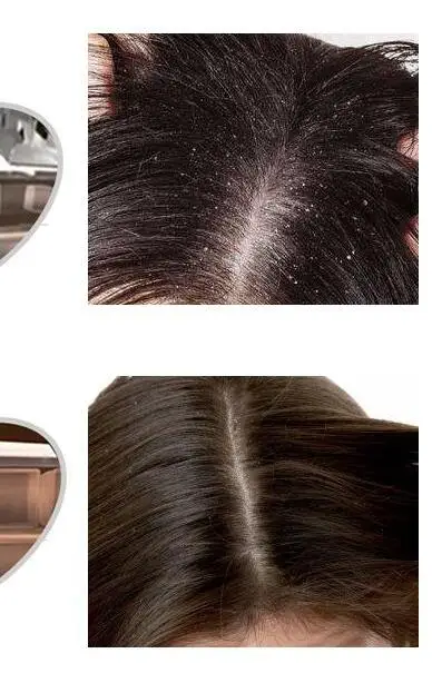 

Compound sulfur ointment cream shampoo, seborrheic, antibacterial, antipruritic, anti-dandruff, silicone oil, shampoo