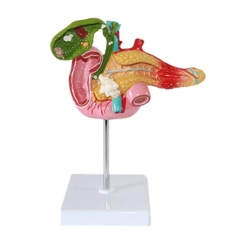 1:1 Size Pancreatic Duodenal Gallbladder Pathological Anatomical Model Gallstone Surgical Digestive System Model Splenic Model