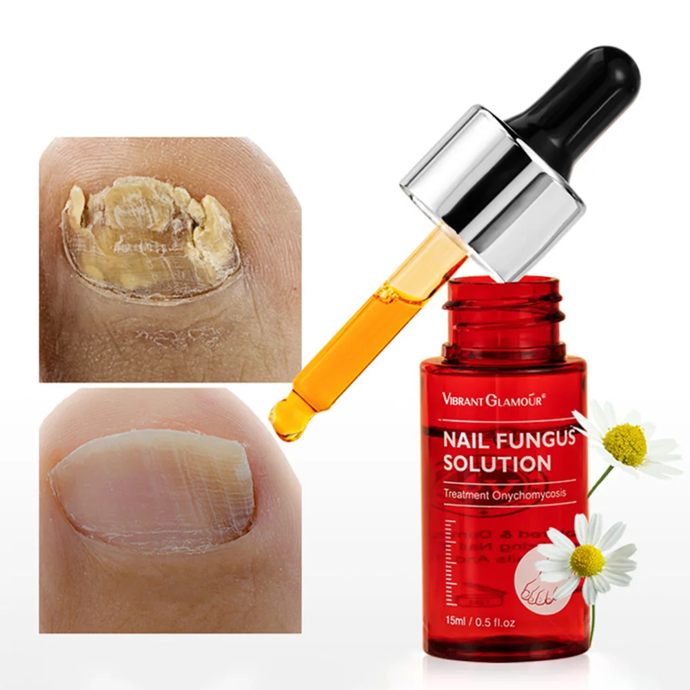 

15ml Nail Fungal Treatment Feet Care Essence Nail Foot Toe Nail Fungus Removal Gel Anti Infection Paronychia Onychomycosis