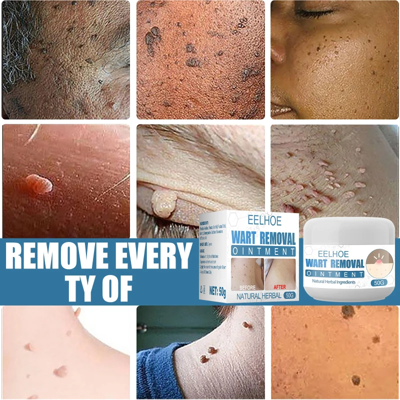 

Wart Treatment Cream Warts Remover Ointment Skin Tag Remover Thorn Pain Relief Cream Antibacterial Wart Treatment Herbal Extract