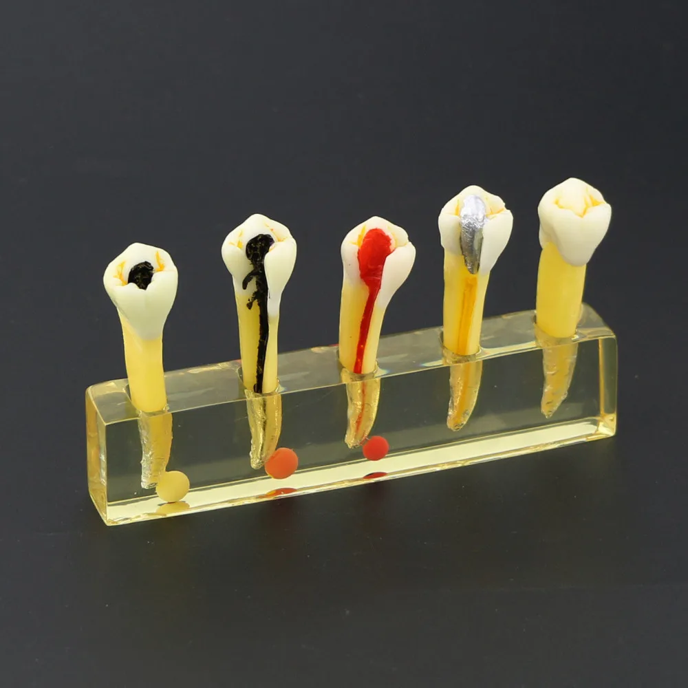 Стоматологическая 5 ступенчатая модель для эндодотического лечения корневых