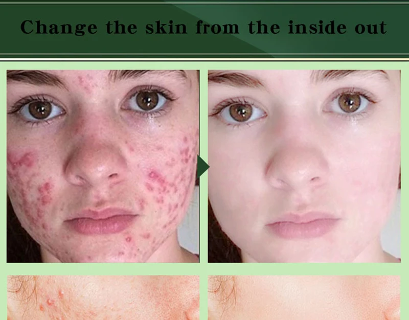 

Effective Acne Removal Cream Acne Treatment Fade Acne Spots Oil Control Shrink Pores Whitening Moisturizing Acne Cream Skin Care