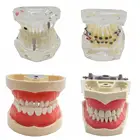 Модель зубов Ортодонтическая с кронштейном, модель зубов и букальной трубки, имплантат лигатуры и модель зубов для восстановления