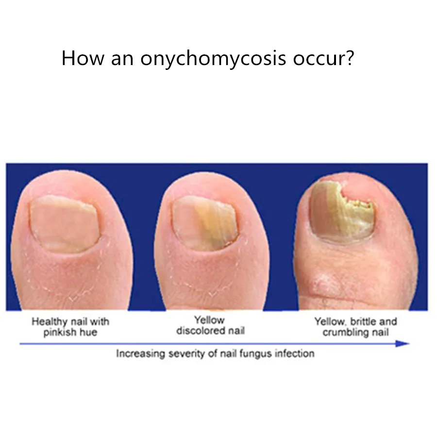 Ноги рук гриб мертвой Уход за ногтями Onychomycosis лечение удалить смягчающее масло стерилизации кутикулы парафин восковой крем
