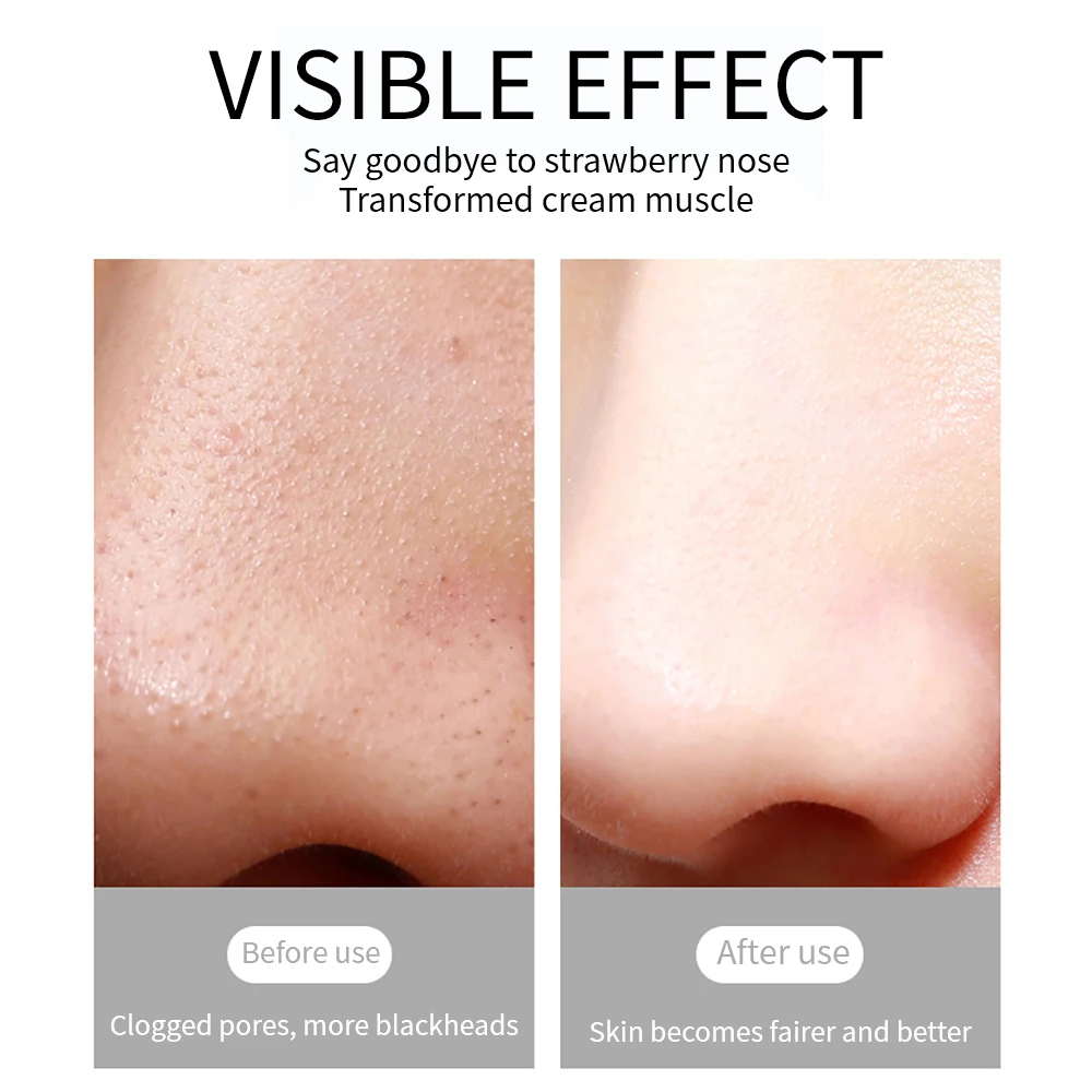 Визуальный пылесос для удаления черных точек со встроенным микроскопом HD-камера