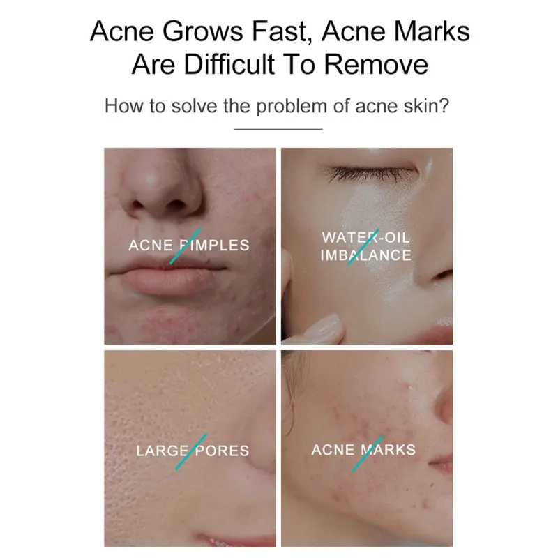 

30g Remove Acne Cream Repair And Brighten Face Pores Pimple Cream Facial Skin Care Cream Tea Tree Anti- Acne Repairing Cream