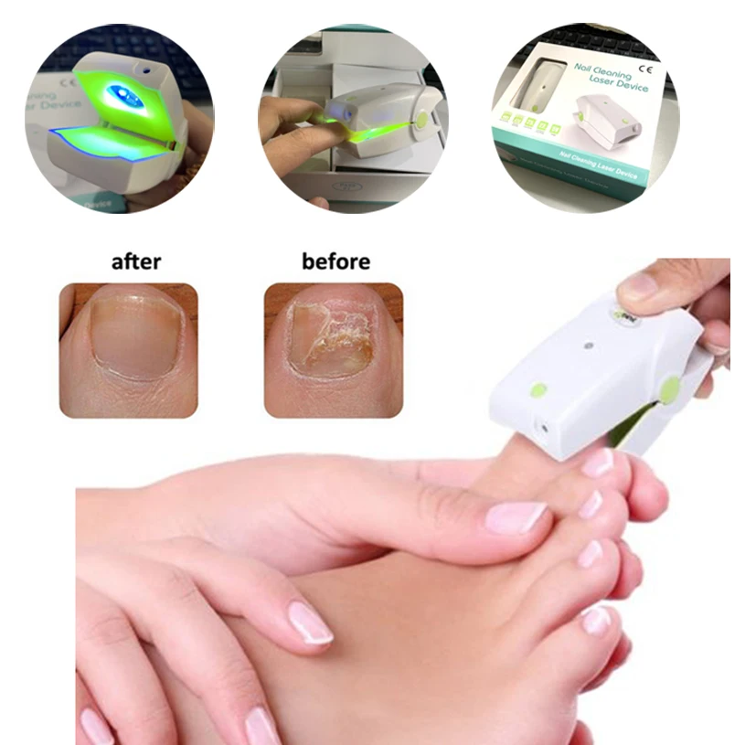 Светильник для лечения грибка ногтей голубой светильник домашнего