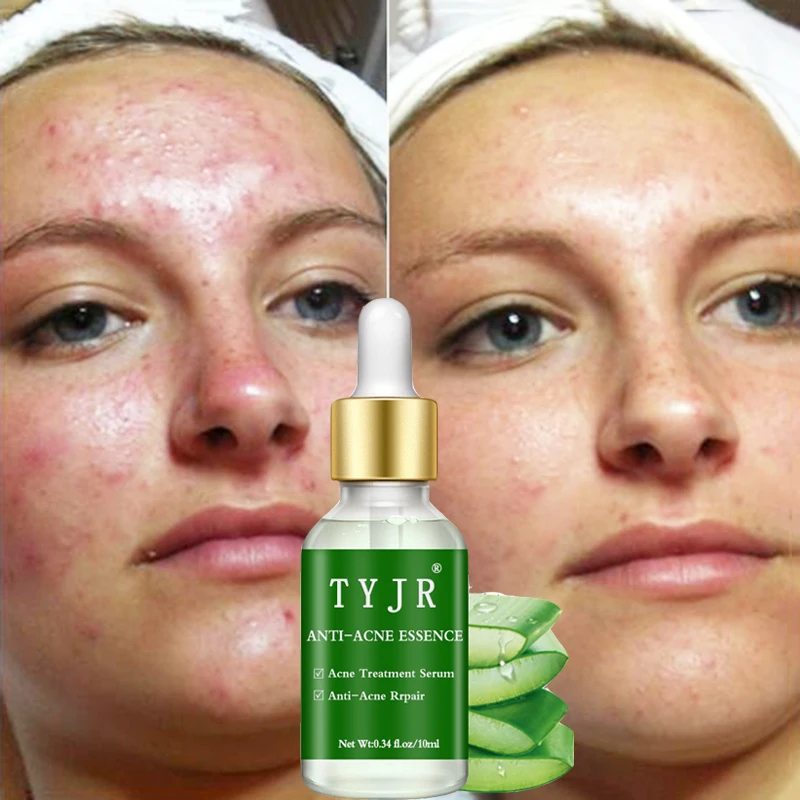Основа под макияж эссенция для акне с алоэ увлажняющее масло кожи сыворотка лица