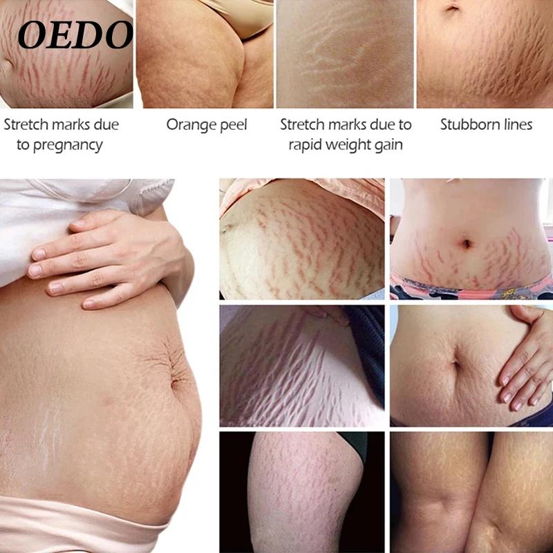 Крем для устранения растяжек и ожирения после родов антивозрастной укрепляющий