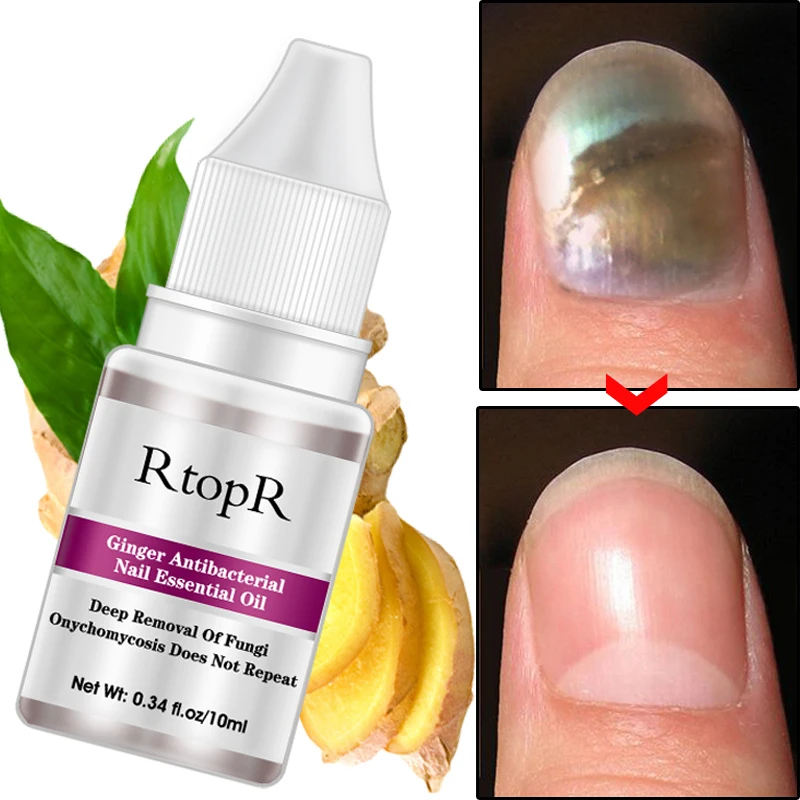 Nail Treatment Essential Oil Toe Finger Anti Fungus Nourishing Care Liquid | Красота и здоровье