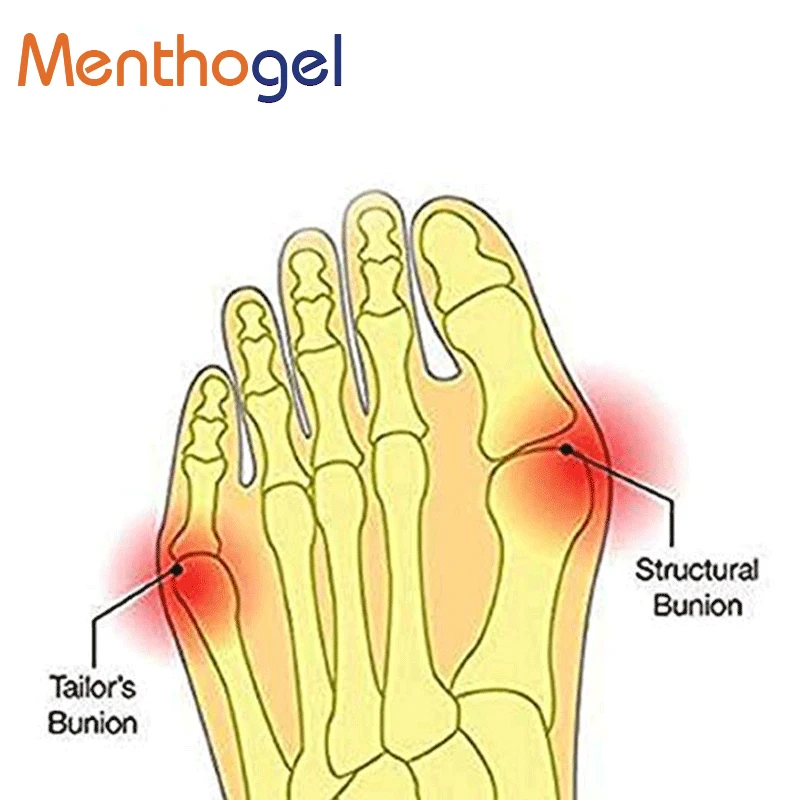 Ментогель Hallux Valgus Стельки силиконовые пальцы 1 отверстие носок сепараторная