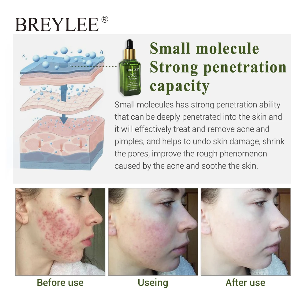 Breylee 2 шт. Сыворотка для лечения акне удаление шрамов от естественная эссенция