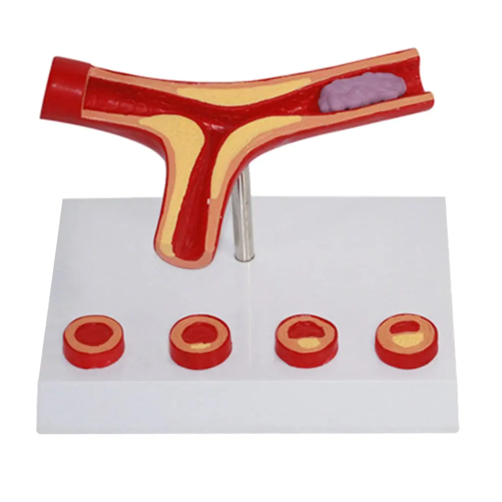 

Atherosclerosis Model Structure Human Vessel Medical Anatomical Model for School Teaching Tool Learning Display