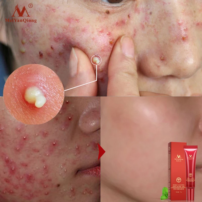 Травяное лечение для удаления акне удаление шрамов на травяной крем быстрая