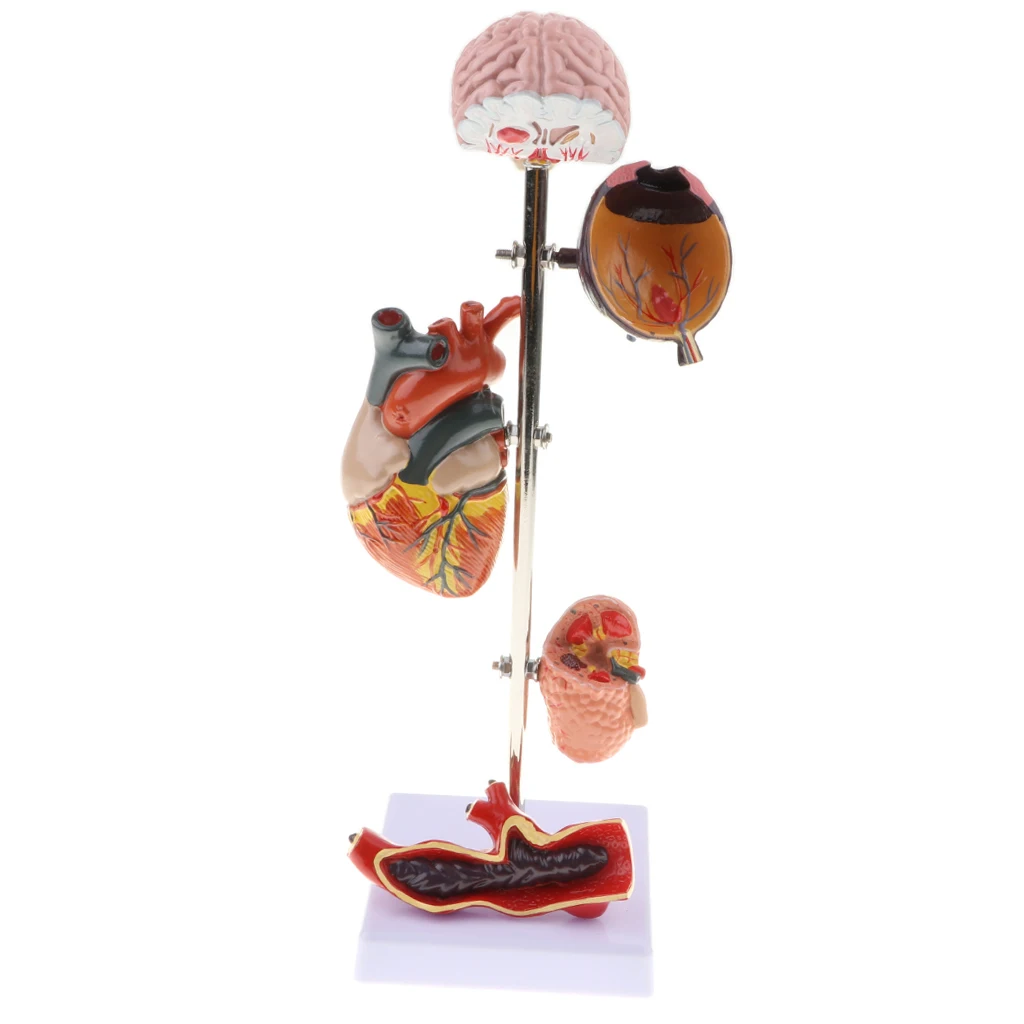 

Removable 5 Parts Pathological Hypertension 5 Parts Model Medical Study Kits Laboratory Ornament with Stand Base