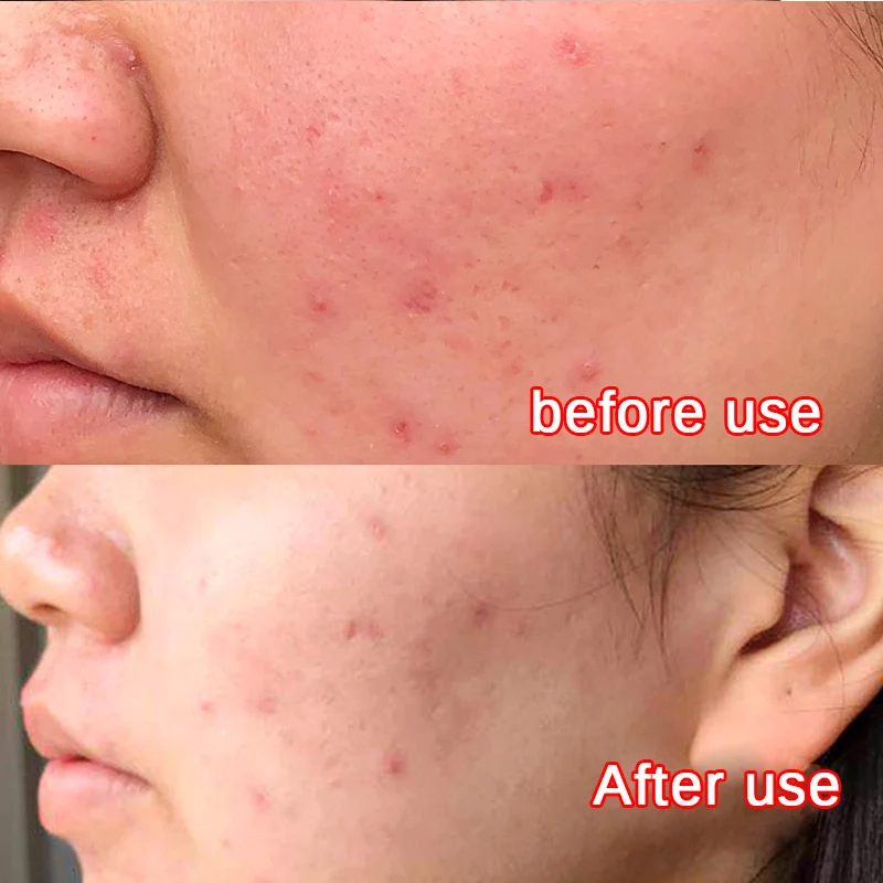 Сыворотка от акне OMY LADY с алоэ вера 100% растительный Крем для лечения рубцов после