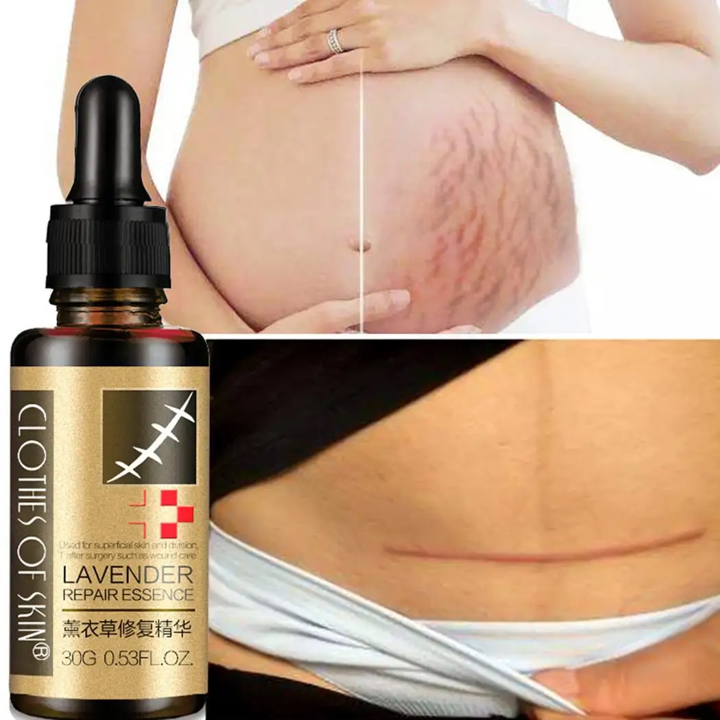 New arrival Acne Scar Removal Cream 30g Natural Facial Skin Repair Stretch mark Treatment Whitening beauty tools | Красота и здоровье