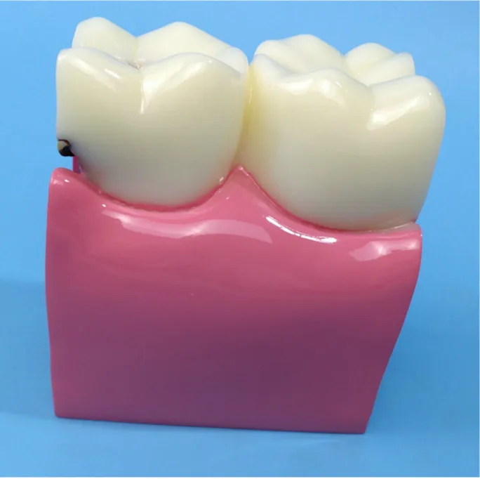 Увеличенная модель зубов человека Oral 6X анатомии кариеса Медицинские Учебные