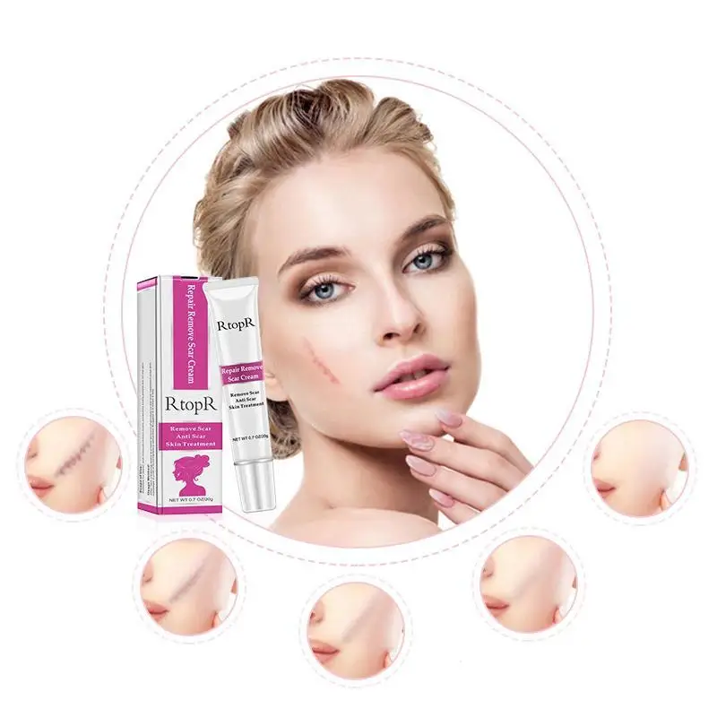 Шрама Strentch Знаки лечение акне поры отбеливающего геля сущность отбеливающий