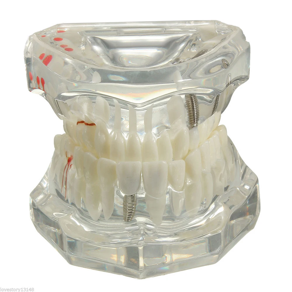 

New Dental Implant Disease Teeth Model With Restoration Bridge Tooth Dentist For Medical Science Dental Disease Teaching Study