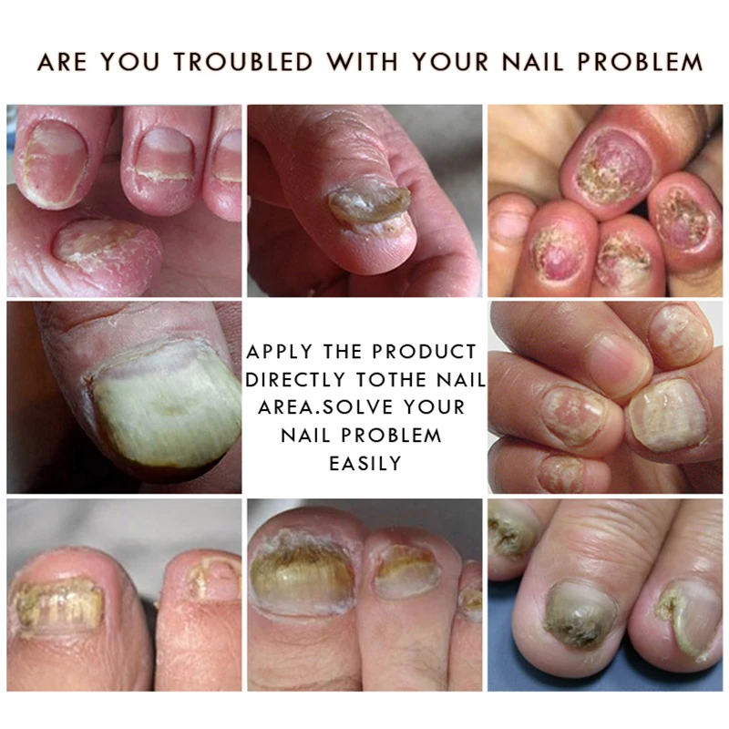 Nail Treatment Essential Oil Toe Finger Anti Fungus Nourishing Care Liquid | Красота и здоровье